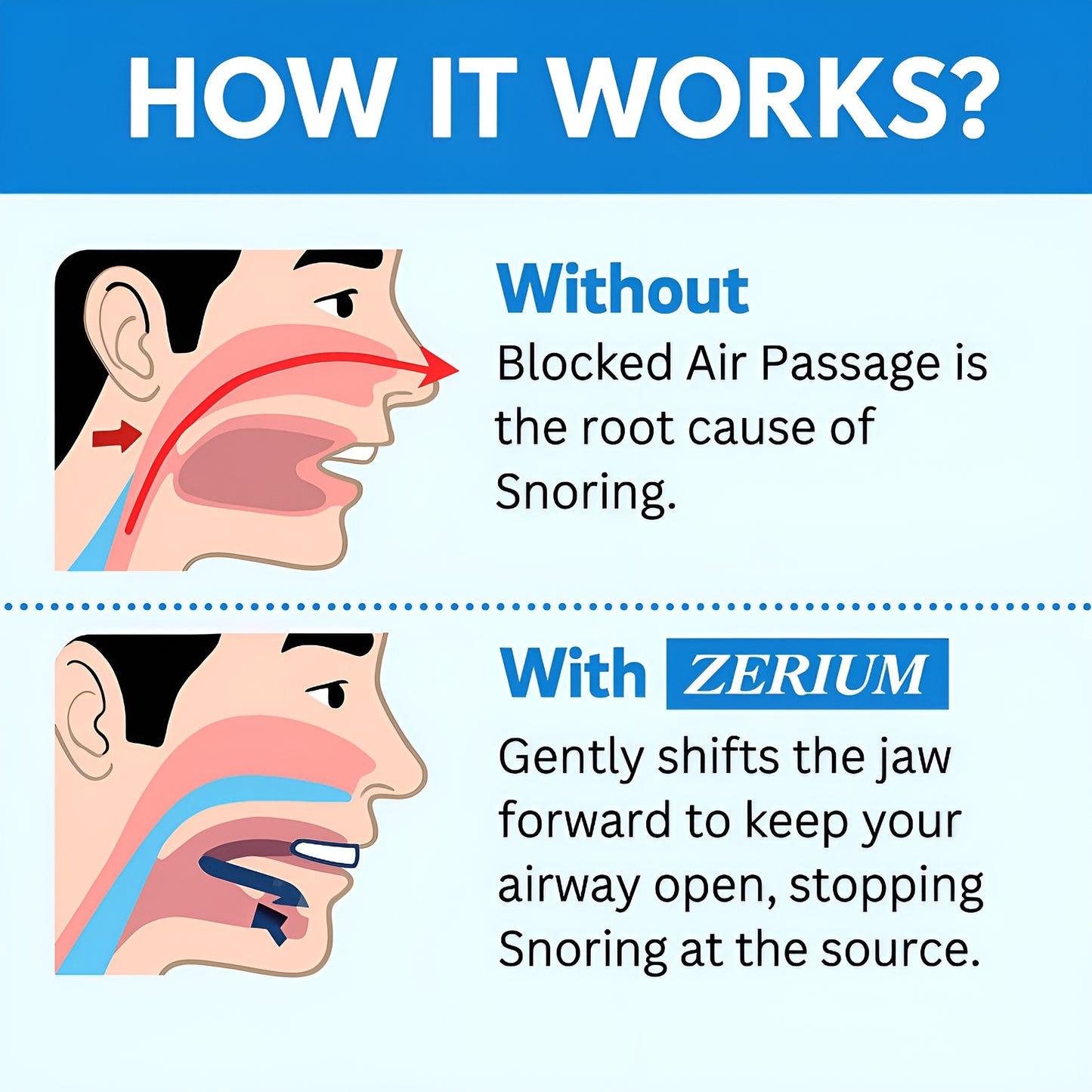 Nuvéra® Anti Snoring Mouthpiece